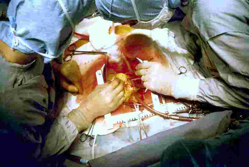 Kalp Bypass Ameliyatı