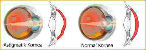 Astigmat Lazer Göz Ameliyatı (SMILE Lazer) Nasıl Yapılır?